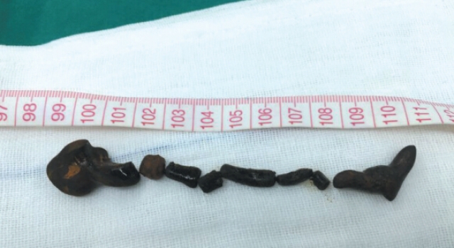 10厘米蛔虫在老妇胆管安家 蛔虫尸体被胆汁包裹成结石