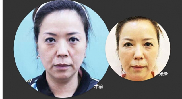玻尿酸填充法令纹越填越深!为什么?
