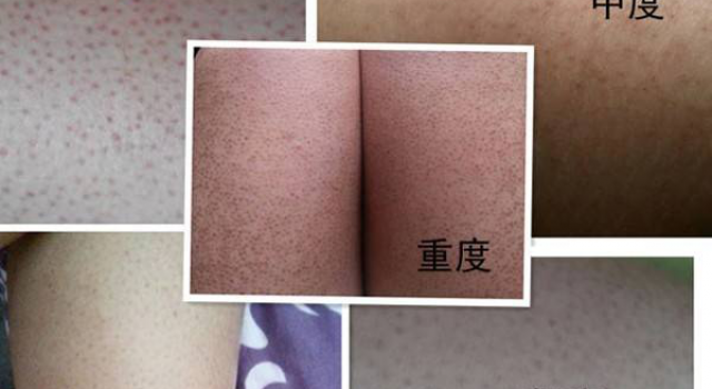 鸡皮肤色素沉淀怎么消除?跟我一起踏上美丽大计征程