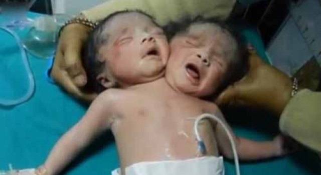 孟加拉再现世间罕见双头婴 如何预防畸形婴儿