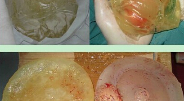 女子8年隆胸假体破裂 “顺胸而下”的硅胶烂穿大腿