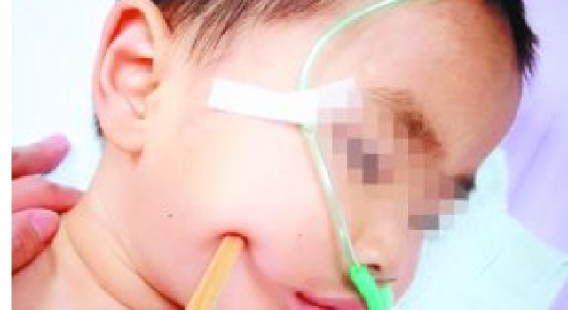 2岁男童拿碗筷玩耍摔倒：筷子插入脑袋 3厘米入颅脑