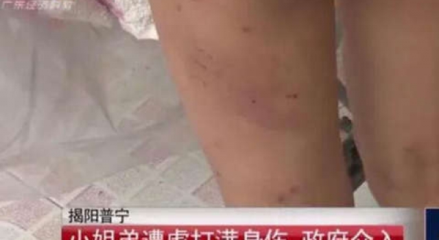 姐弟遭生父继母虐打体无完肤：浇一身尿 不给饭吃
