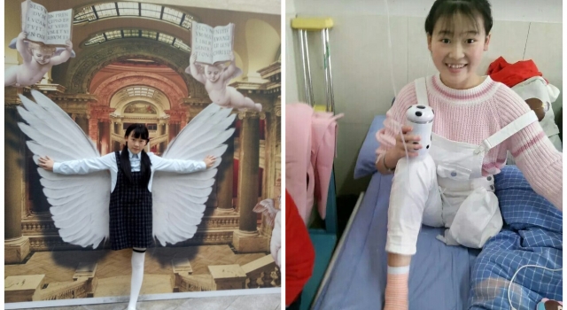 她是患癌的独腿天使 死前欲捐献眼角膜