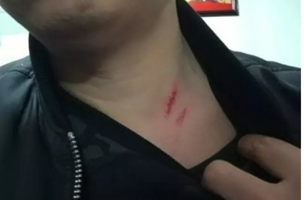 云南男子被强行做结扎手术 当地:他超生 符合规定