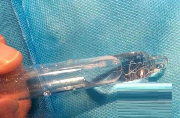 太可怕！老太眼睛不舒服 医生竟从眼中取出8条活虫子