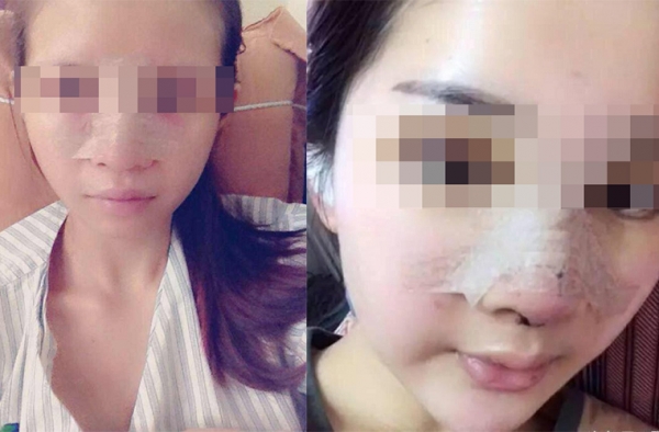 女子鼻贴胶布被劝下飞机 当事人：我真的没整容！
