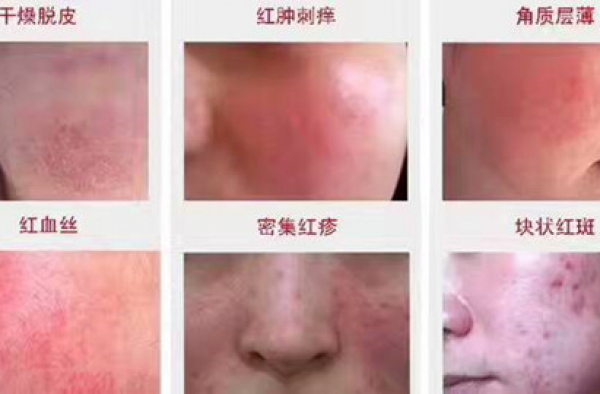 激素脸排毒高峰期反跳症状图？排什么毒？持续多久？怎么才能好