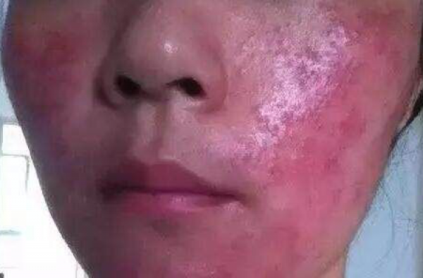 脸有激素怎么办？激素脸在家怎样治疗
