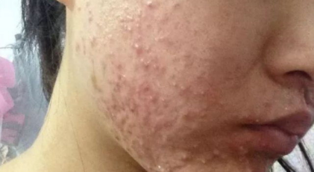 激素脸有炎症怎么治疗 推荐激素脸的治疗土方法