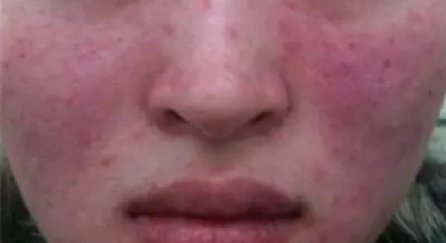 激素脸裸脸可以自愈吗？严重激素脸裸脸能自愈吗