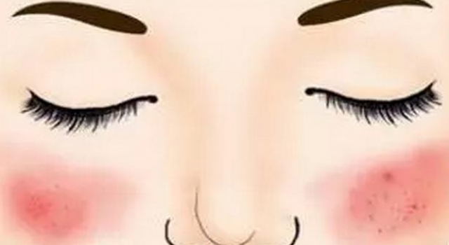 脸过敏了又红又痒怎么办 分析脸反复过敏是激素脸吗