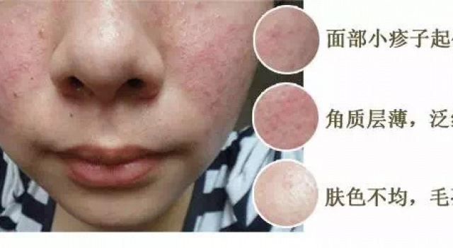 激素脸戒断是什么意思？激素脸戒断反应会出现哪些症状