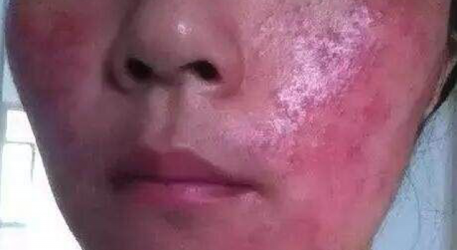 激素脸逆光疹子怎么办 那激素脸排毒多久不会痒