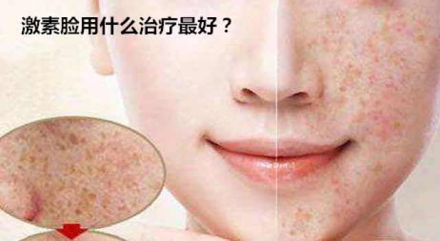 激素脸如何彻底治疗？那么激素脸用什么治疗最好
