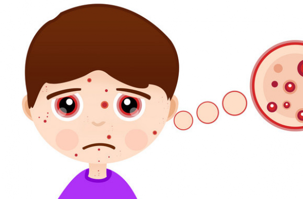 激素脸满脸小疹子怎么办？激素脸排毒过程中很痒专业方法拯救你