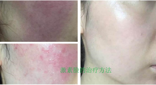 排激素脸多久才会好？如何把脸上激素排掉
