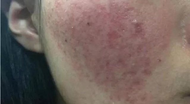这三个祛痘要点 千万要注意 否则痘痘更严重