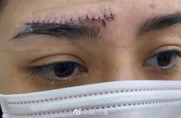 阿娇晒伤口照片，数十针缝合恐留下疤痕，日后还要靠遮瑕度日